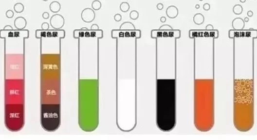 尿h科学家发现尿液中的新型生物标志物有助于早期诊断多种疾病