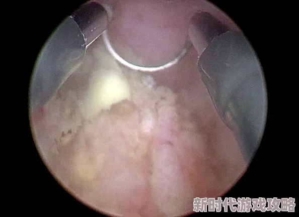胡桃尿道口流出白色脓状物是什么？专家解析背后可能隐藏的健康风险与治疗方案！