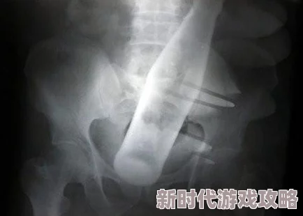 学校要求戴肛塞学生家长反映校方强制推行此项规定引发强烈争议